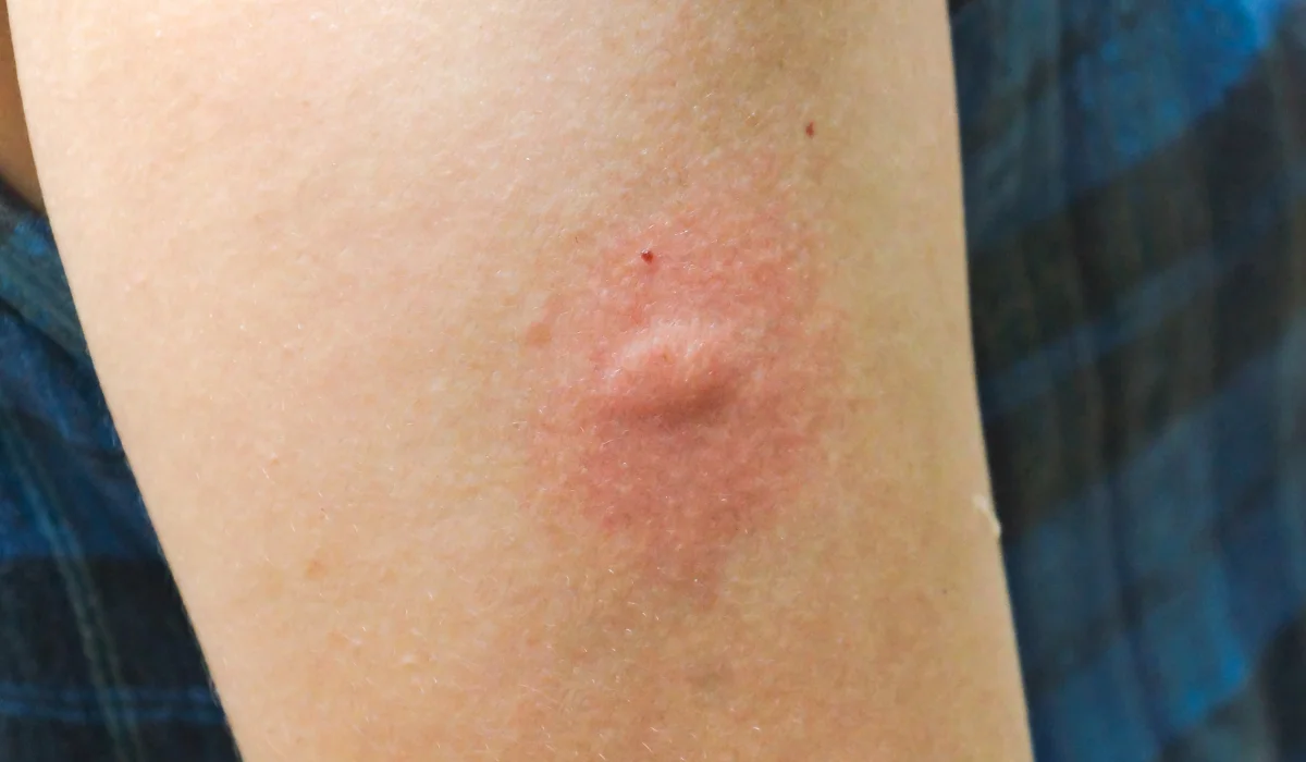 flea vs mosquito bite