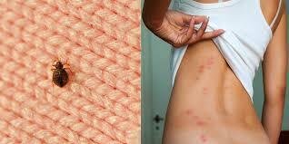 How to Get Rid of Bug Bite Scars: Fast Remedies & Skin Healing Tips How to Get Rid of Bug Bite Scars