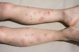 Allergic Reaction to Mosquito Bite Treatment