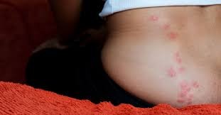 bug bites in a straight line