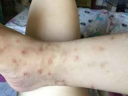 Scarring from Bug Bite Treatment