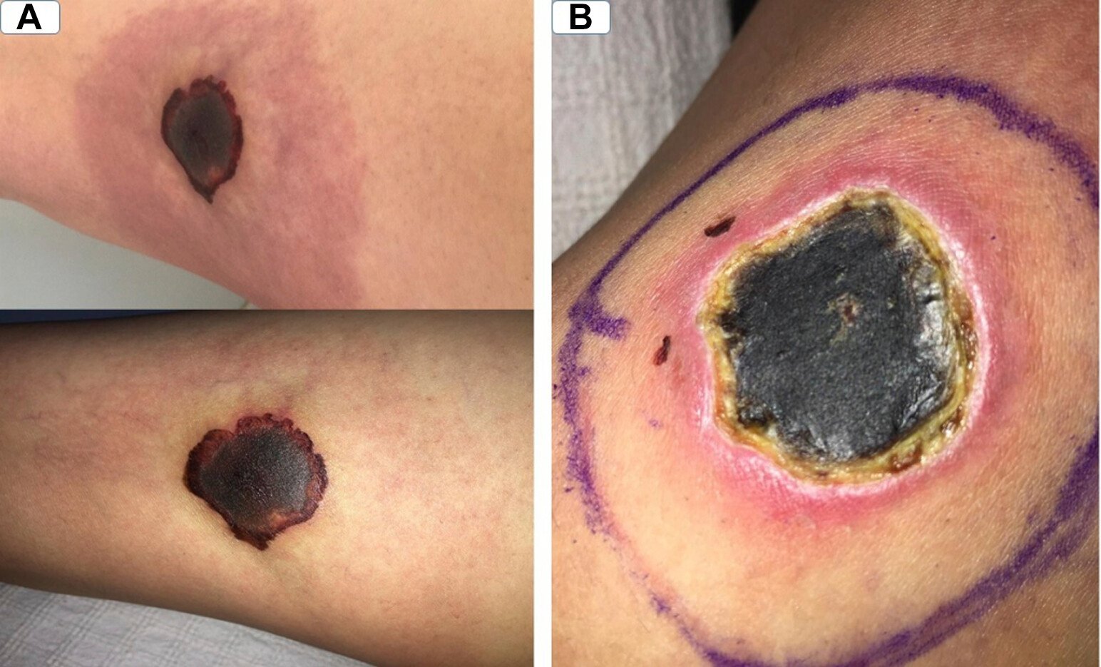permanent skin discoloration