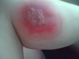 take child to doctor for spider bite