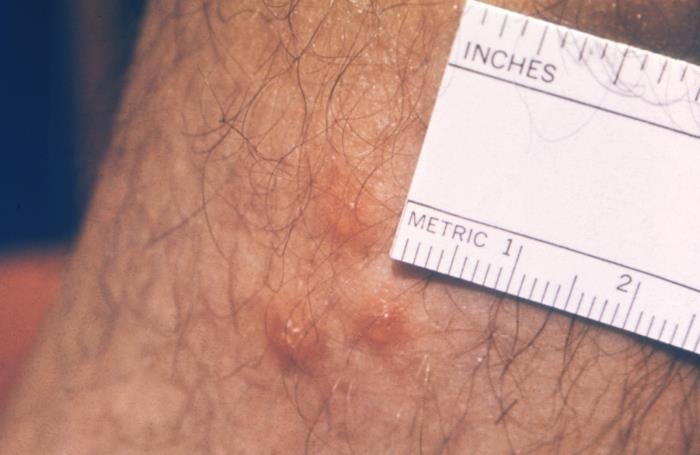 CDC PHIL clinical photograph showing three erythematous chigger bites on a patient’s arm