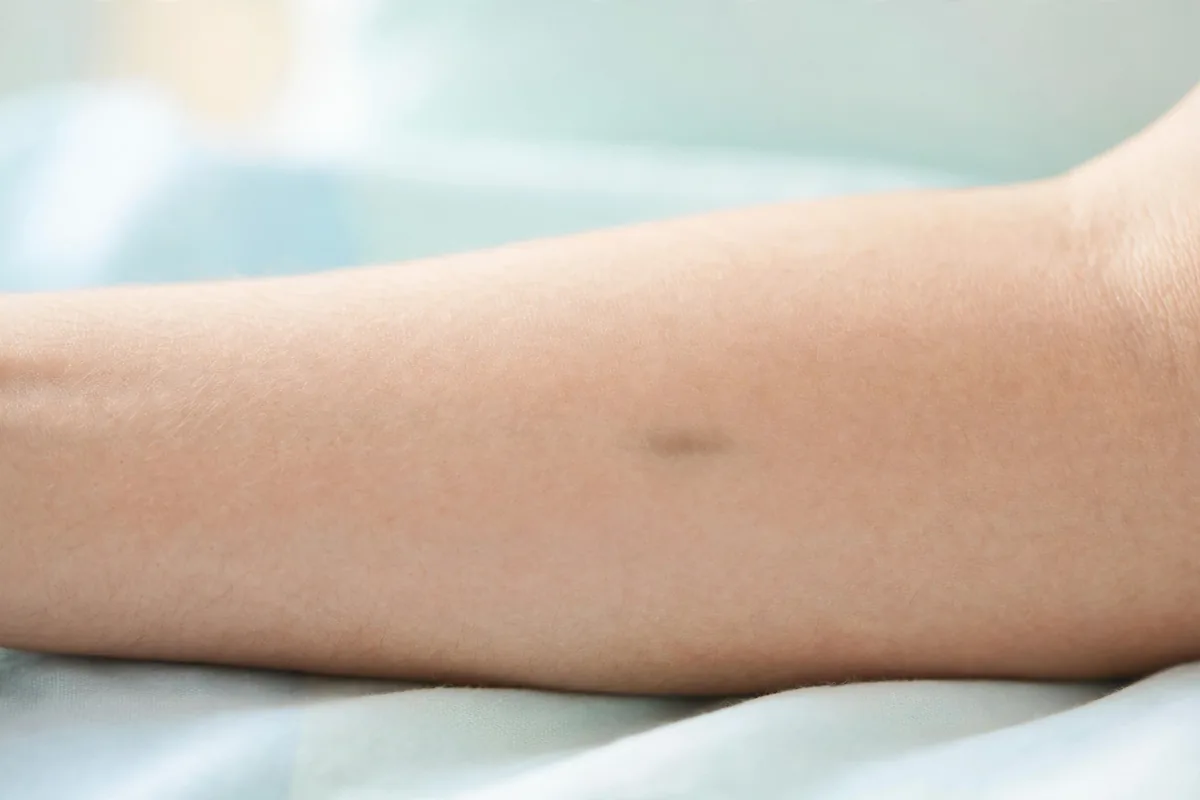 When a Bite Scar or Dark Mark May Fade - image 1