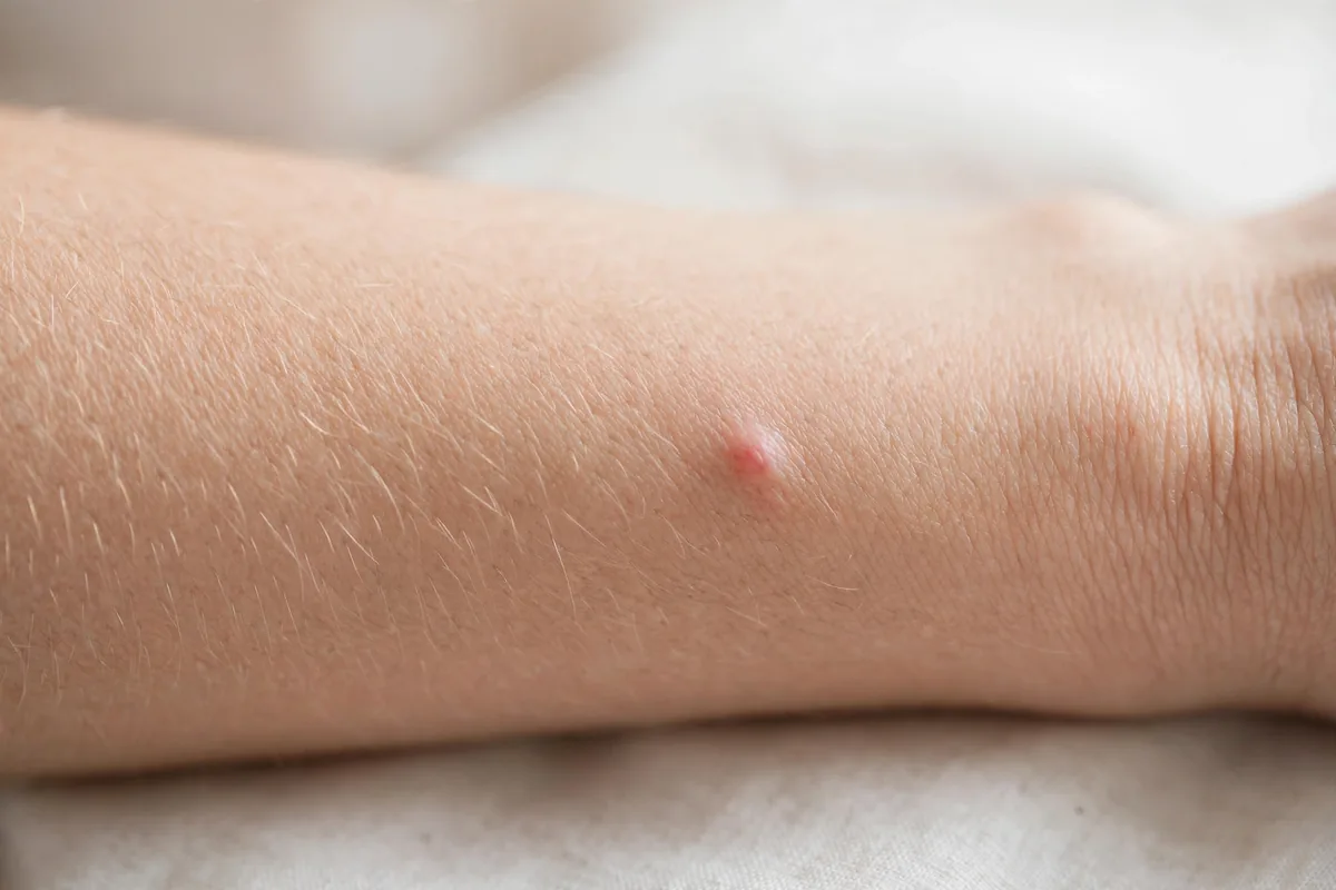 Normal Bite Healing vs Possible Infection - image 1