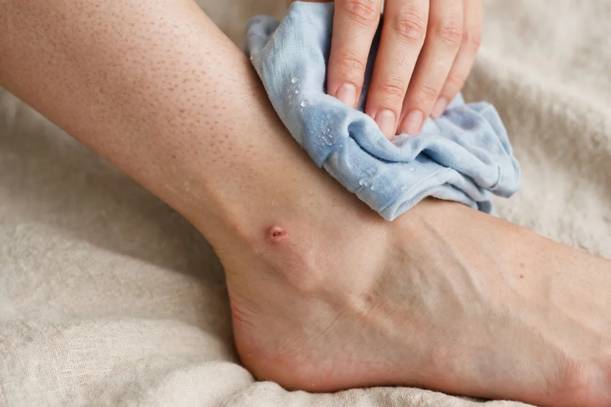 Black Fly Bite vs Mosquito Bite: ID - illustration 3